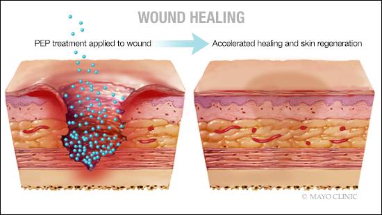 Image shows accelerated dwound-healing with use of peptide treatment